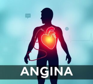 Krūtinės angina
