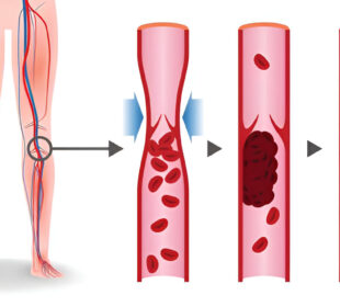 Gerybinis fascikuliacijų sindromas