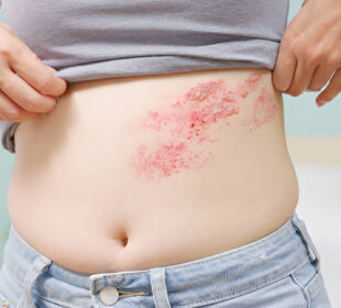 Juostinė pūslelinė