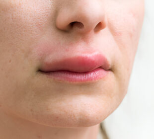 Patinusios lūpos