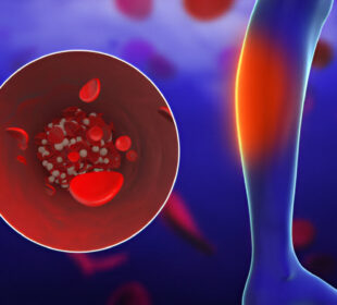 Periferinė arterijų liga