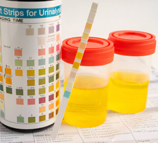 Šlapimo spalvos pokyčia