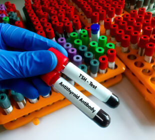 Antitirolobulino tyrimas skydliaukės būklei įvertinti