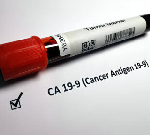 CA 19-9 Testas dėl kasos vėžio