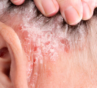 Eritroderminė psoriazė