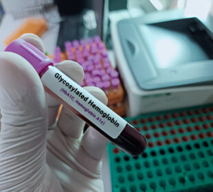 Glikozilinto hemoglobino testo svarba ir procedūra diabeto kontrolei