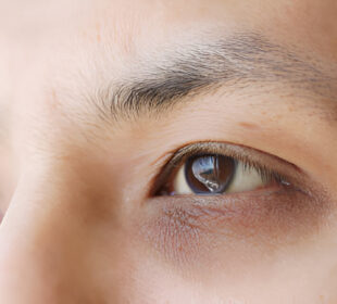 Tamsūs ratilai po akimis