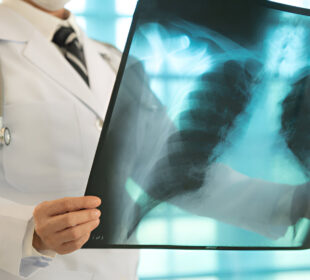 Žalingi įpročiai tuberkuliozės spąstuose