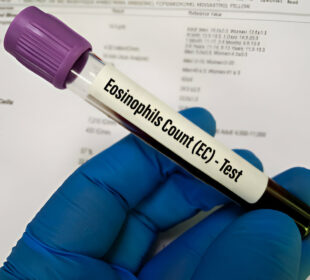 Tikslaus absoliutaus eozinofilų skaičiaus tyrimas ir rezultatai