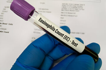 Tikslaus absoliutaus eozinofilų skaičiaus tyrimas ir rezultatai