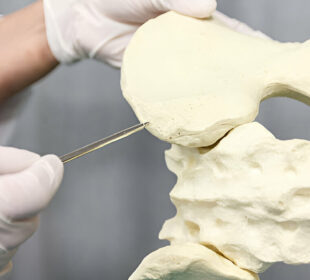 ką reikia žinoti apie kaulų čiulpų biopsijas